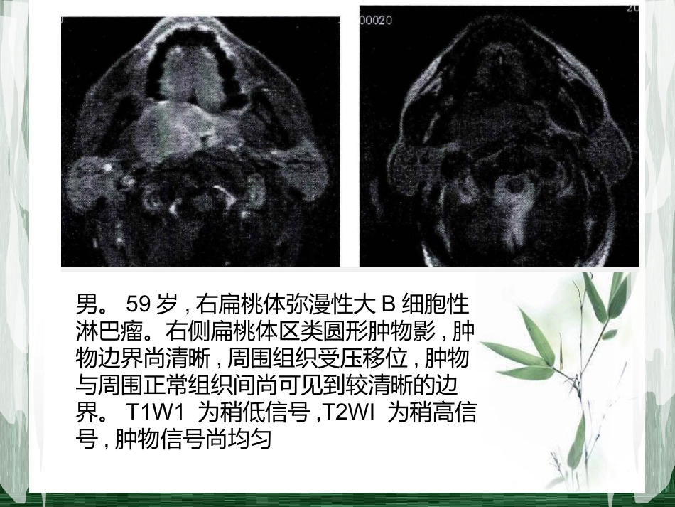 扁桃体淋巴瘤影像诊断_第10页