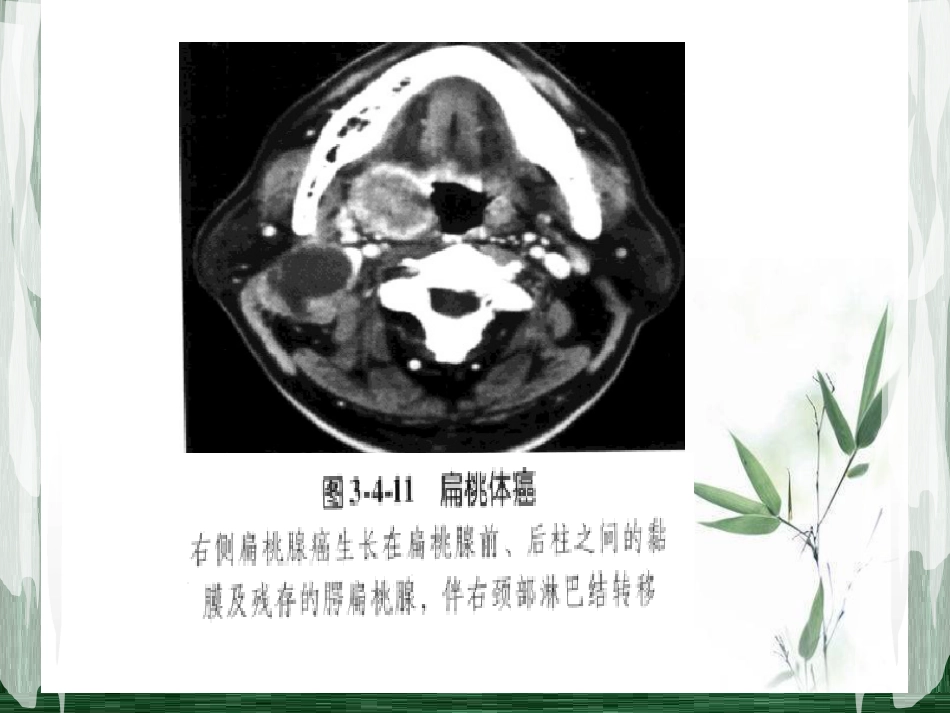扁桃体淋巴瘤影像诊断_第13页