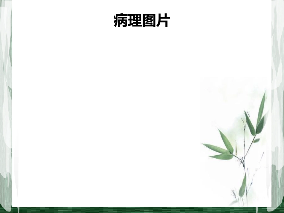 扁桃体淋巴瘤影像诊断_第4页