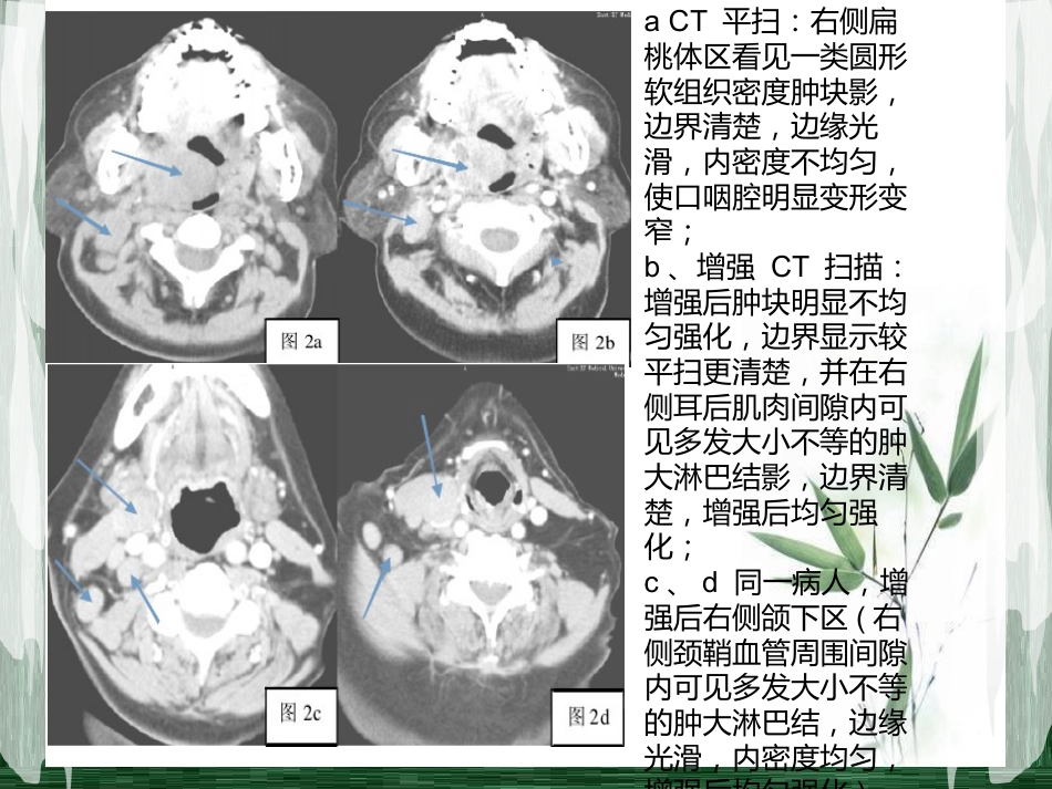 扁桃体淋巴瘤影像诊断_第9页