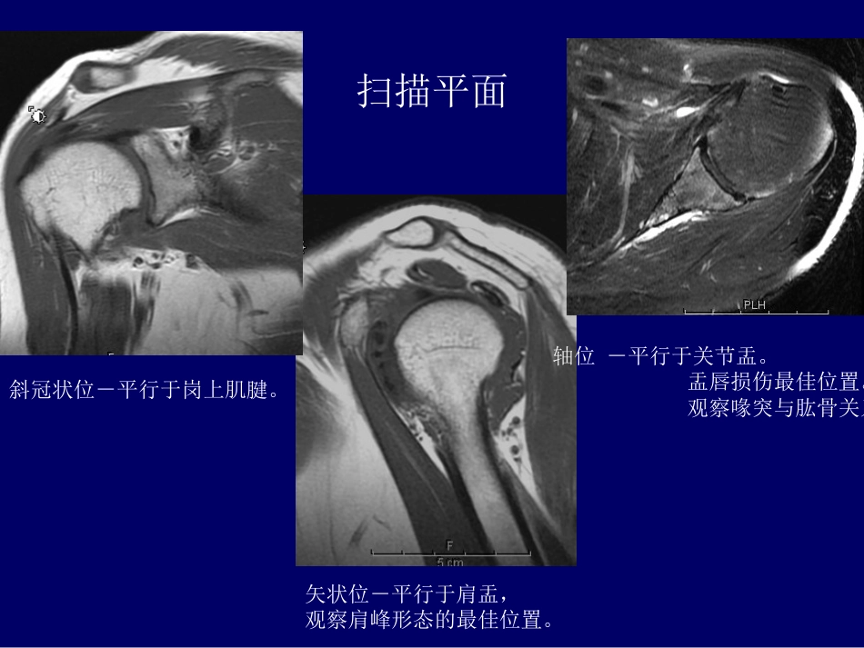 外影像与诊断学：：肩关节应用解剖及腱鞘肌腱病的磁共振影像诊断_第12页