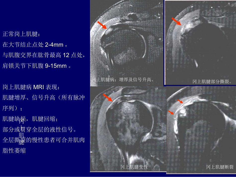 外影像与诊断学：：肩关节应用解剖及腱鞘肌腱病的磁共振影像诊断_第14页