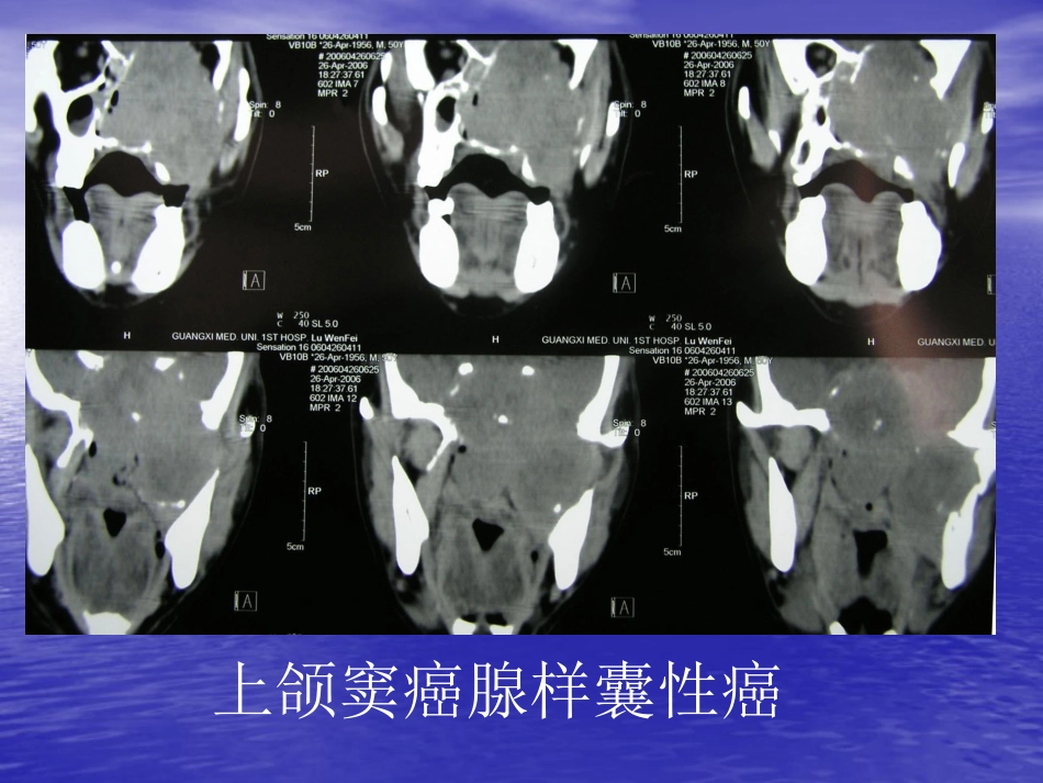 鼻窦肿瘤影像学表现_第10页