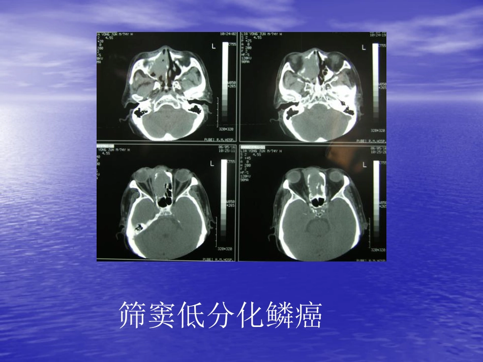 鼻窦肿瘤影像学表现_第11页