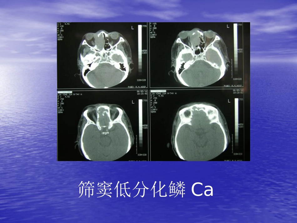 鼻窦肿瘤影像学表现_第12页