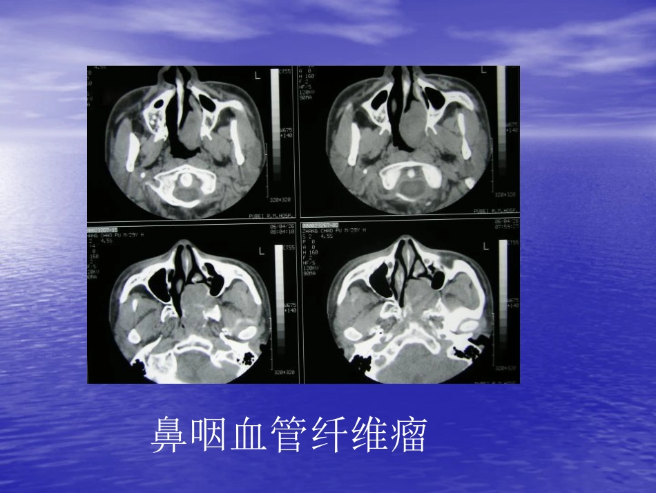 鼻窦肿瘤影像学表现_第13页