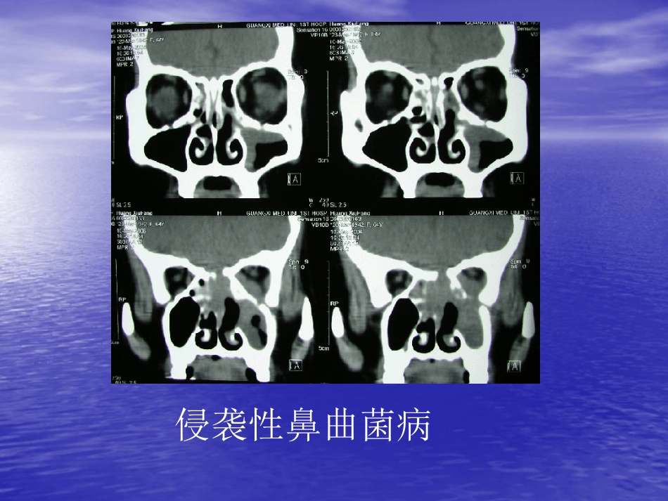 鼻窦肿瘤影像学表现_第14页