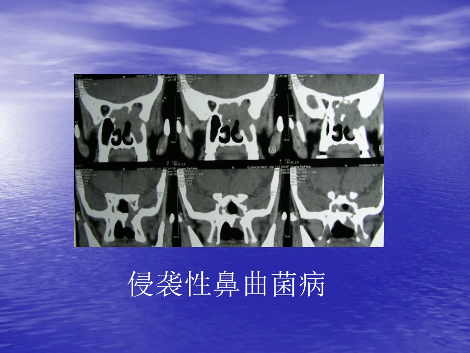 鼻窦肿瘤影像学表现_第15页