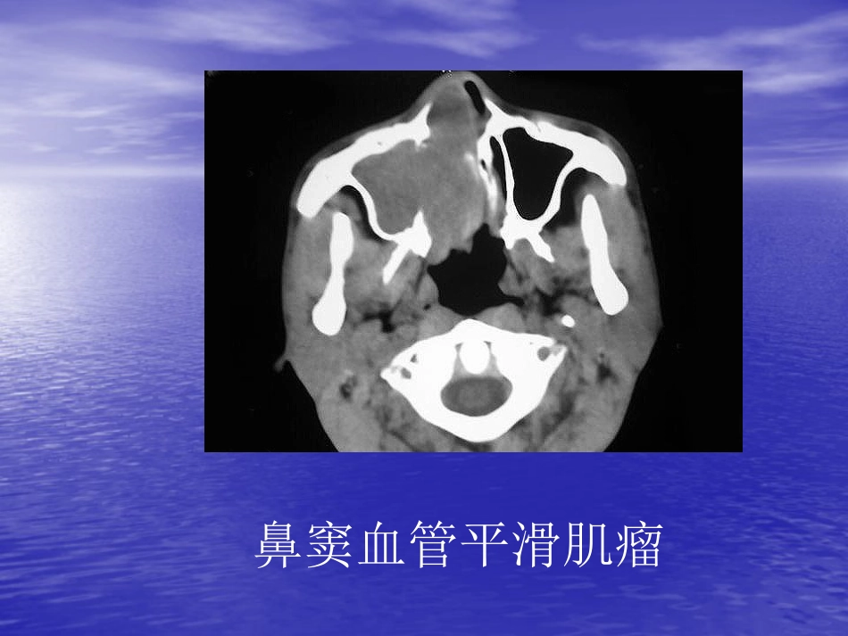 鼻窦肿瘤影像学表现_第2页