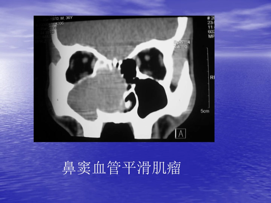 鼻窦肿瘤影像学表现_第3页