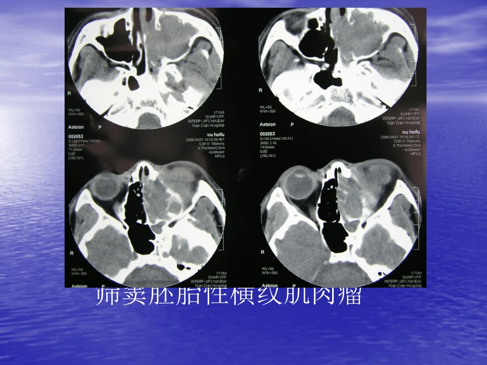 鼻窦肿瘤影像学表现_第4页