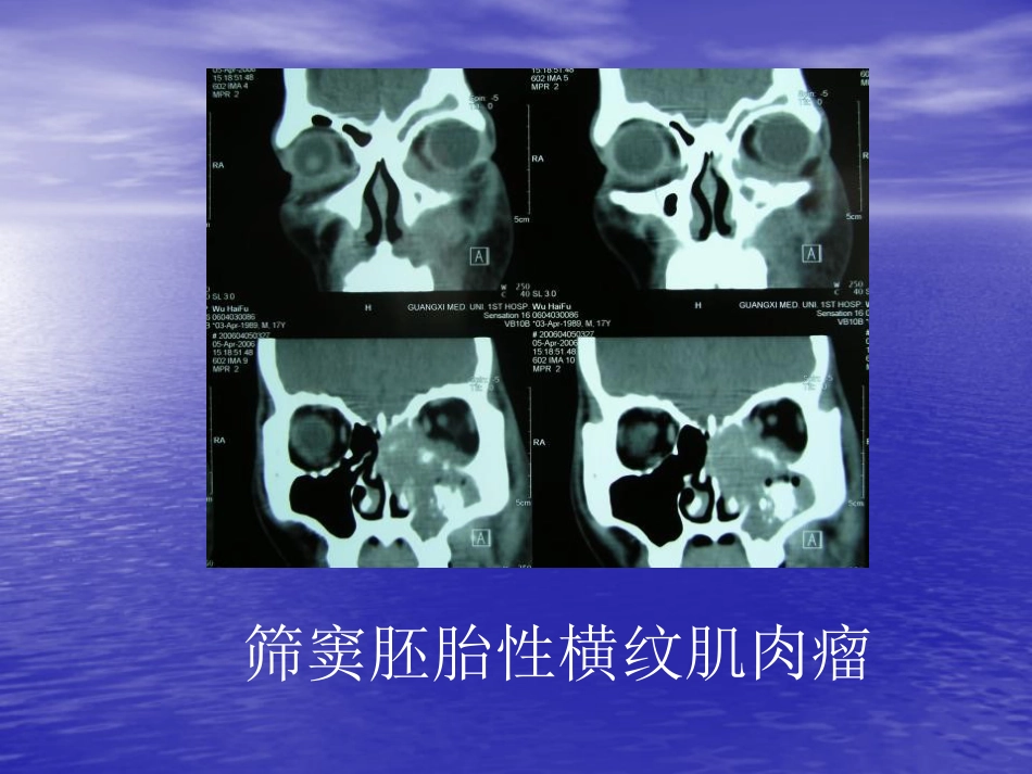 鼻窦肿瘤影像学表现_第5页