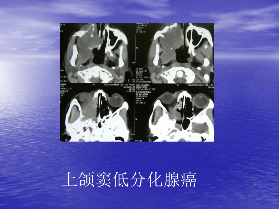 鼻窦肿瘤影像学表现_第6页