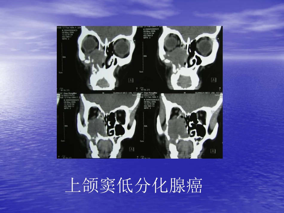 鼻窦肿瘤影像学表现_第7页