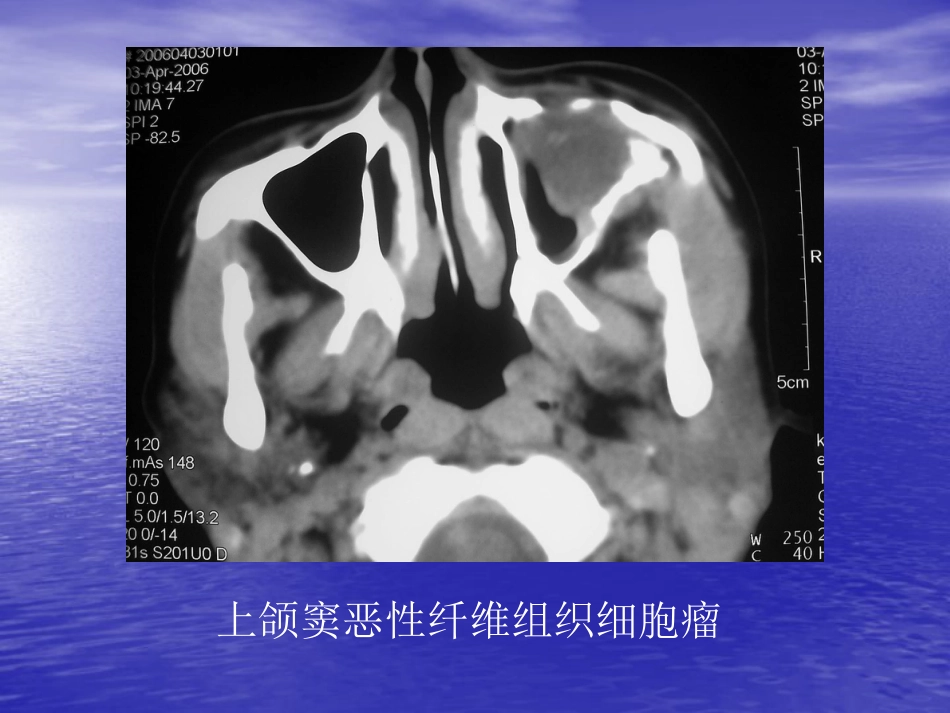 鼻窦肿瘤影像学表现_第8页