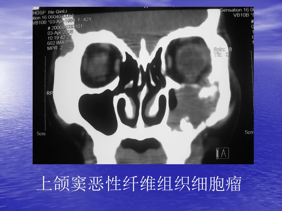 鼻窦肿瘤影像学表现_第9页