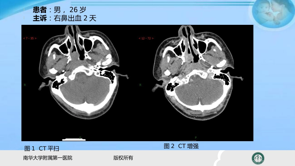 鼻咽纤维血管瘤的影像表现及临床 ppt课件_第2页
