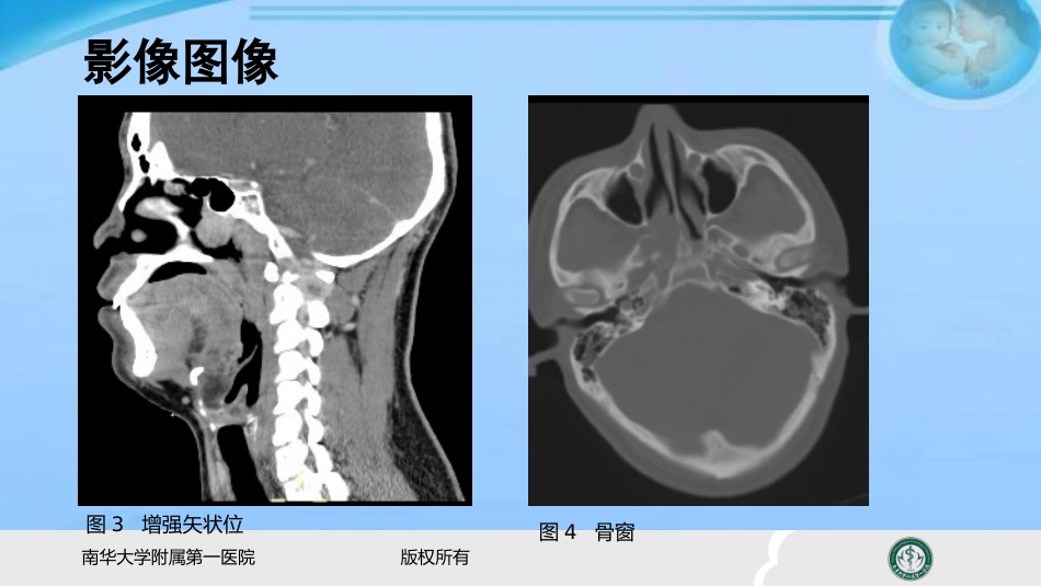 鼻咽纤维血管瘤的影像表现及临床 ppt课件_第3页