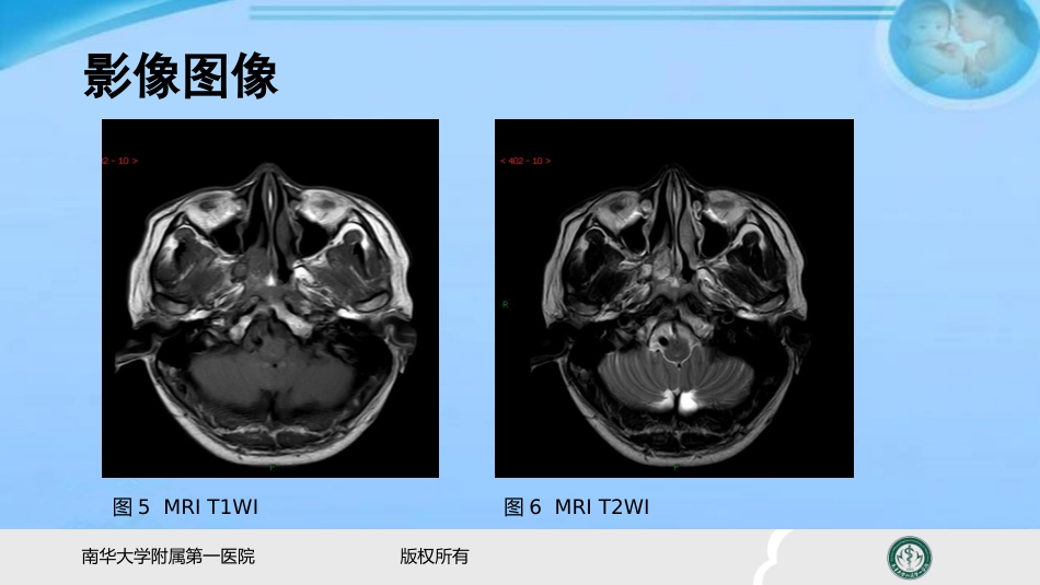 鼻咽纤维血管瘤的影像表现及临床 ppt课件_第4页
