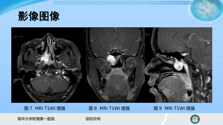 鼻咽纤维血管瘤的影像表现及临床 ppt课件_第5页