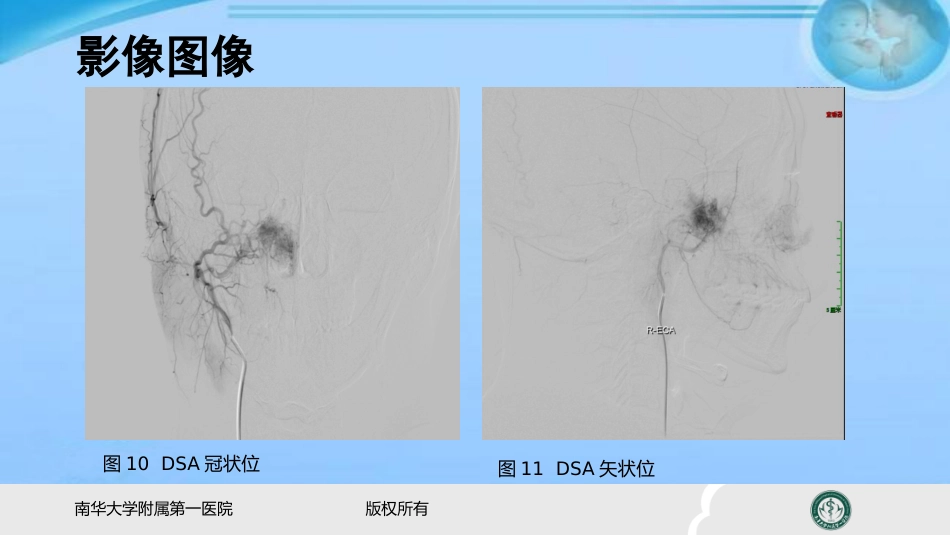 鼻咽纤维血管瘤的影像表现及临床 ppt课件_第6页