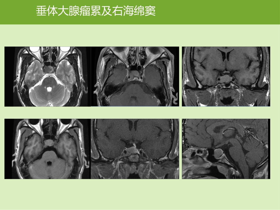 鞍区肿瘤的影像诊断与鉴别诊断_第11页
