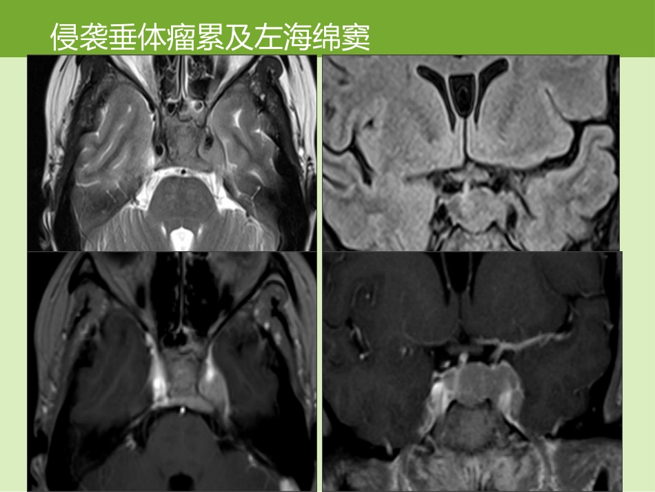 鞍区肿瘤的影像诊断与鉴别诊断_第12页