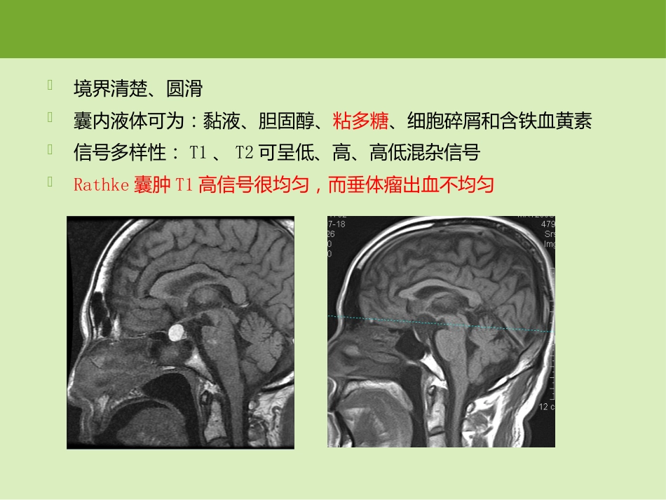 鞍区肿瘤的影像诊断与鉴别诊断_第14页