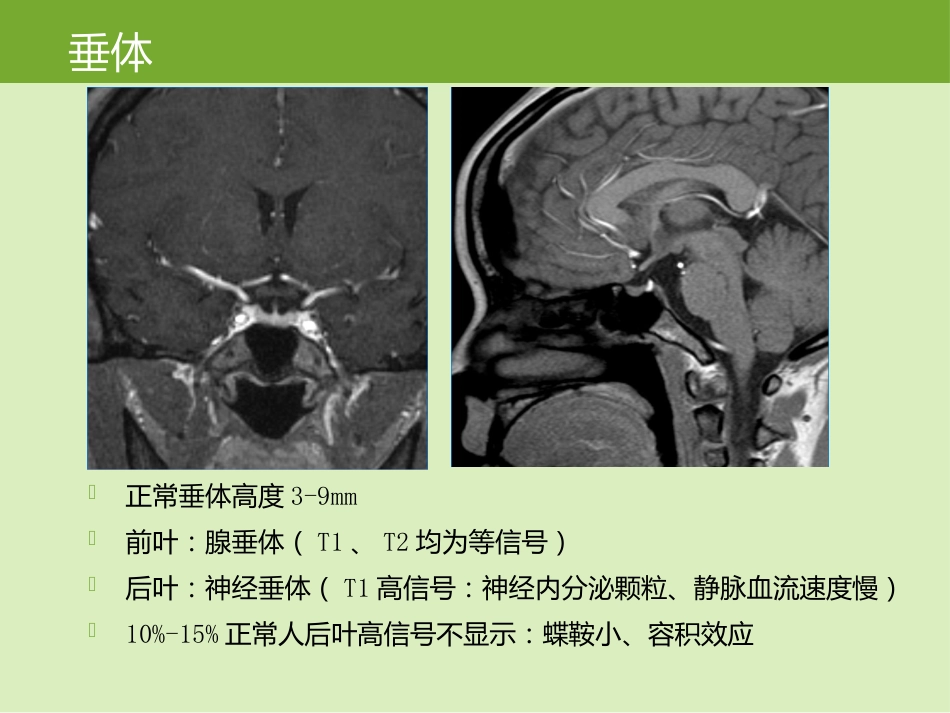 鞍区肿瘤的影像诊断与鉴别诊断_第3页