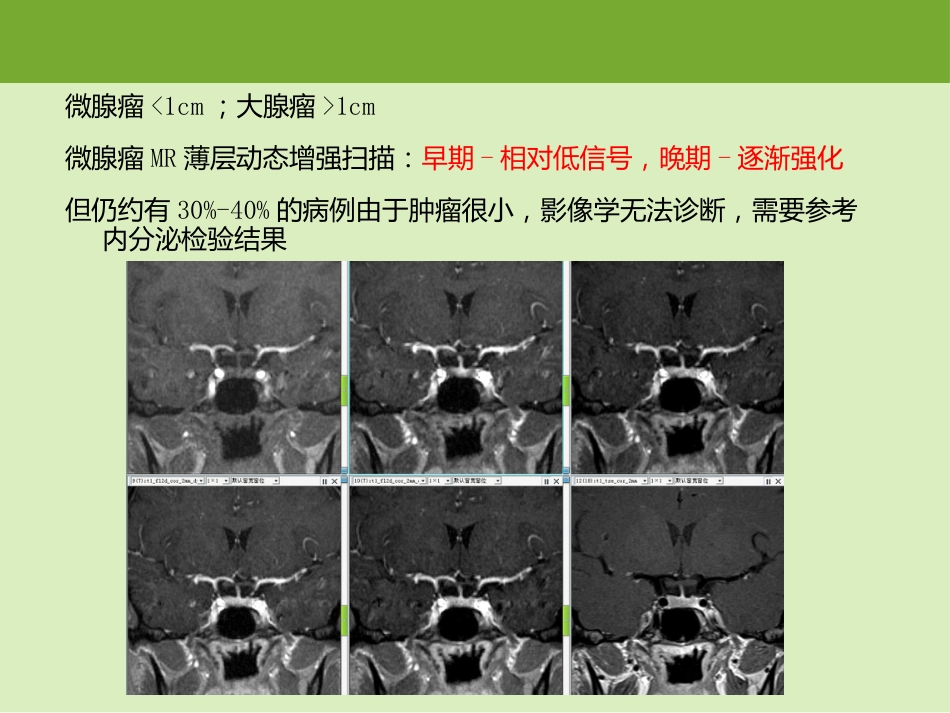 鞍区肿瘤的影像诊断与鉴别诊断_第6页