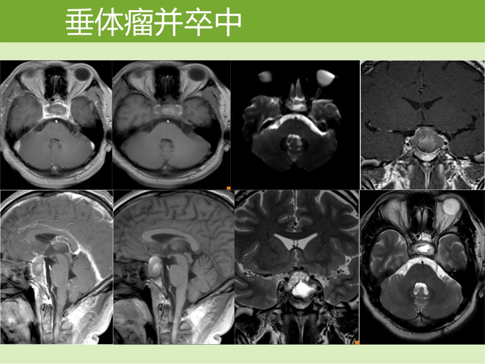 鞍区肿瘤的影像诊断与鉴别诊断_第9页