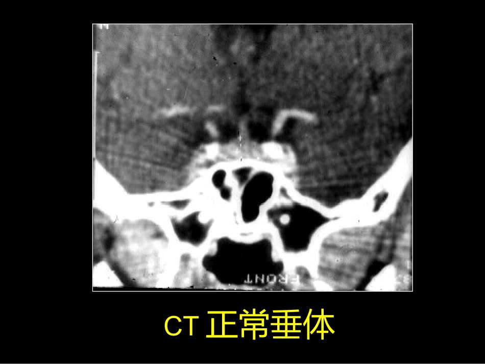 鞍区解剖-断层影像解剖ppt课件_第12页