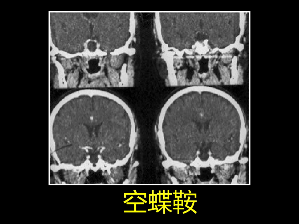 鞍区解剖-断层影像解剖ppt课件_第13页