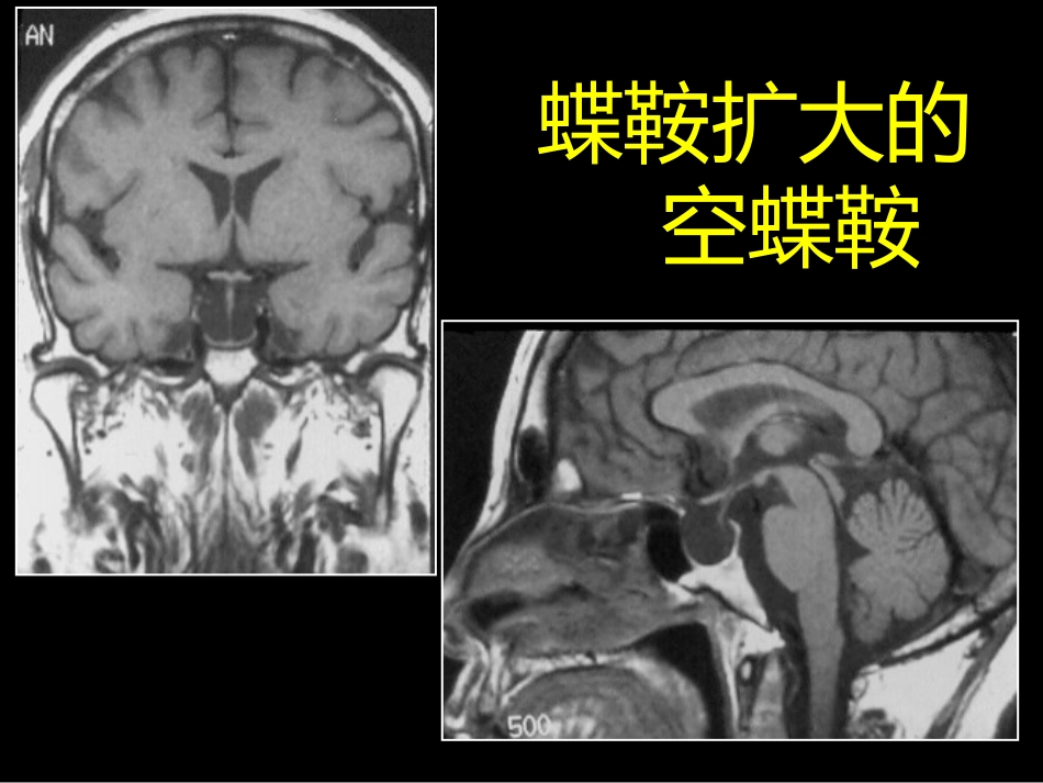 鞍区解剖-断层影像解剖ppt课件_第14页