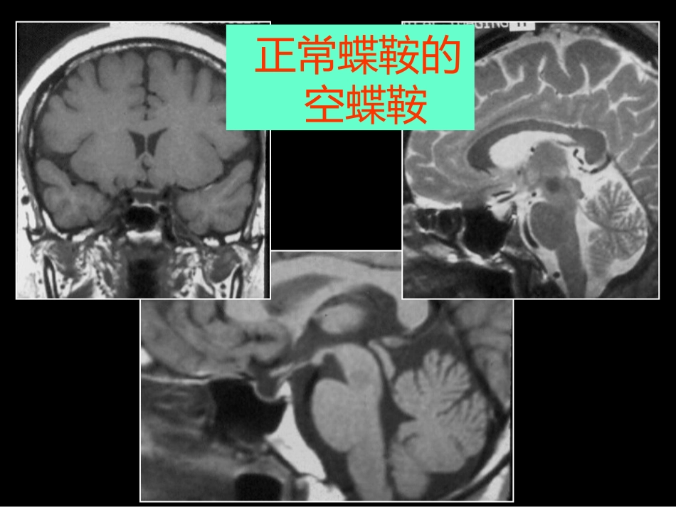 鞍区解剖-断层影像解剖ppt课件_第15页