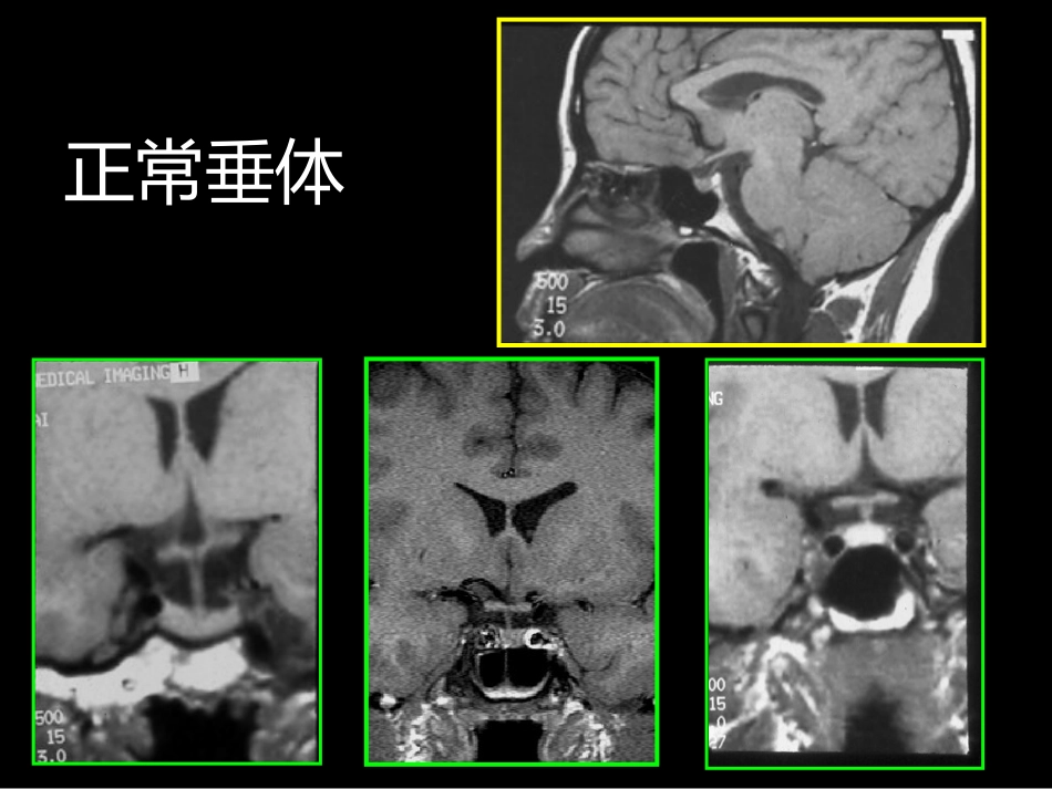 鞍区解剖-断层影像解剖ppt课件_第3页