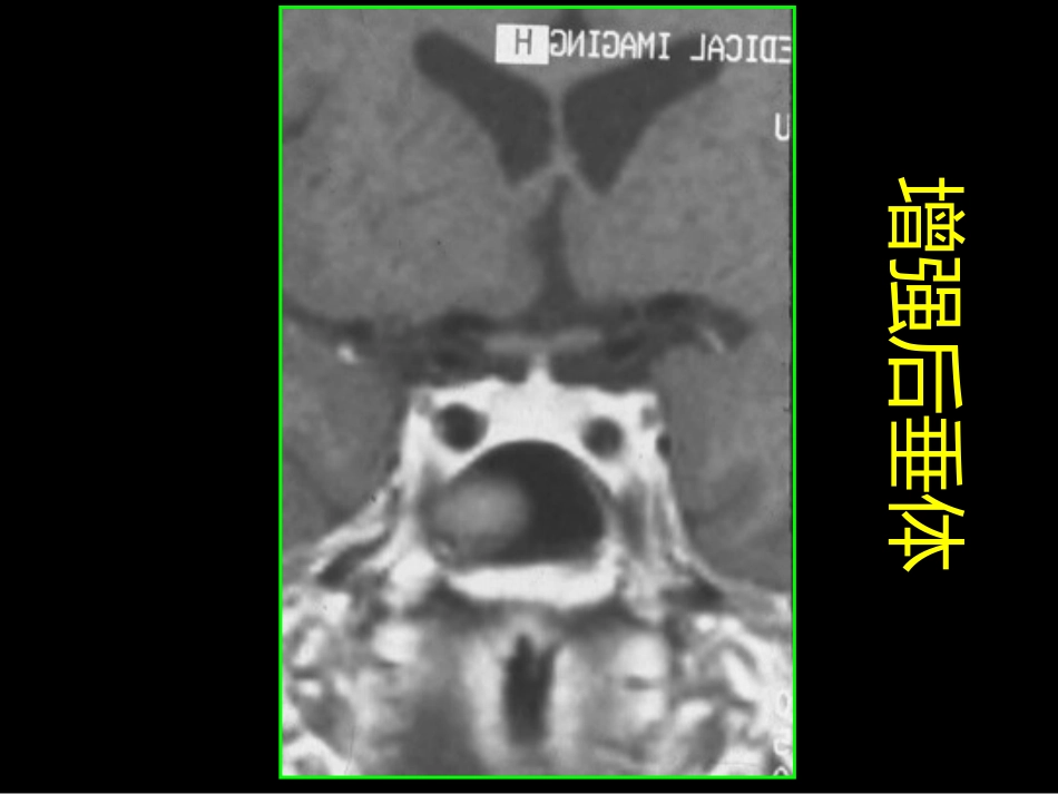 鞍区解剖-断层影像解剖ppt课件_第4页