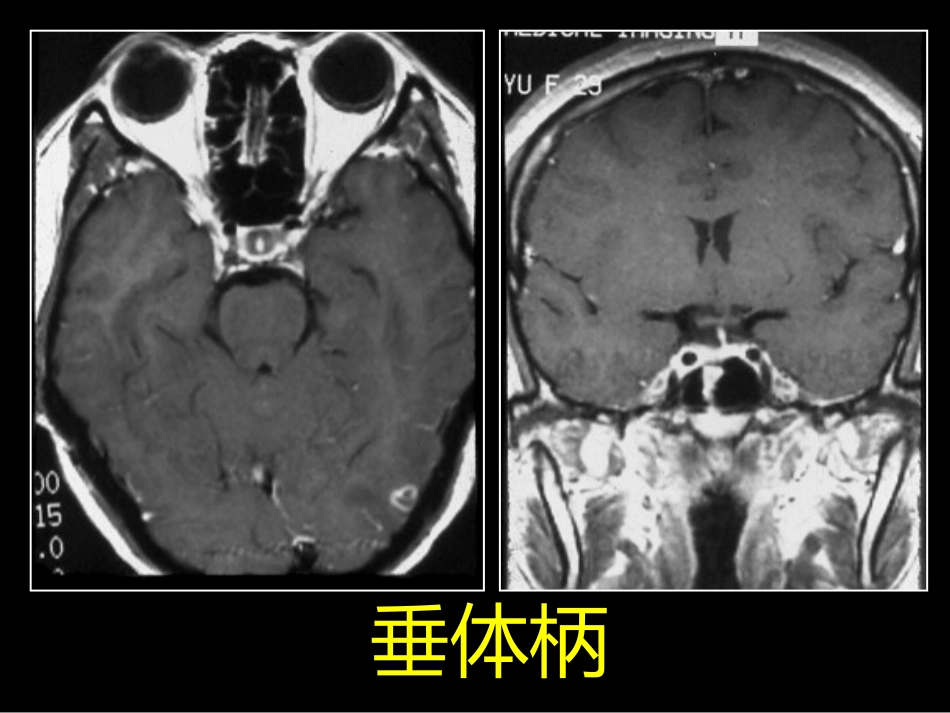鞍区解剖-断层影像解剖ppt课件_第5页
