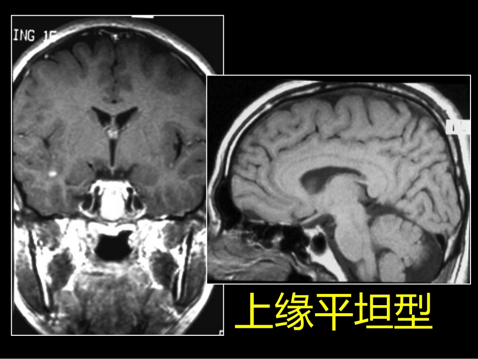 鞍区解剖-断层影像解剖ppt课件_第6页