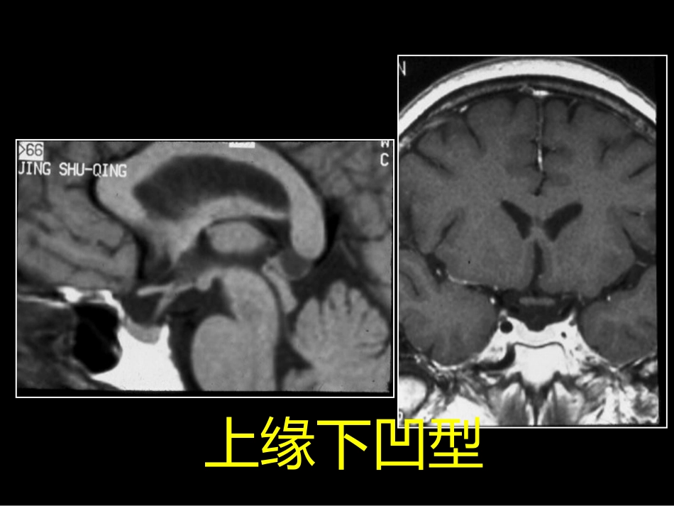鞍区解剖-断层影像解剖ppt课件_第7页