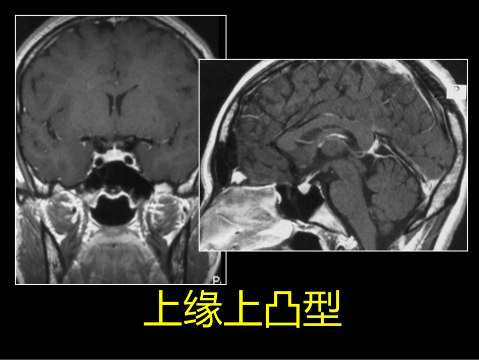 鞍区解剖-断层影像解剖ppt课件_第8页