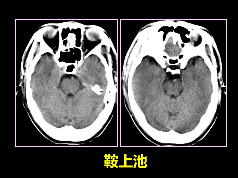 鞍区解剖-断层影像解剖ppt课件_第9页