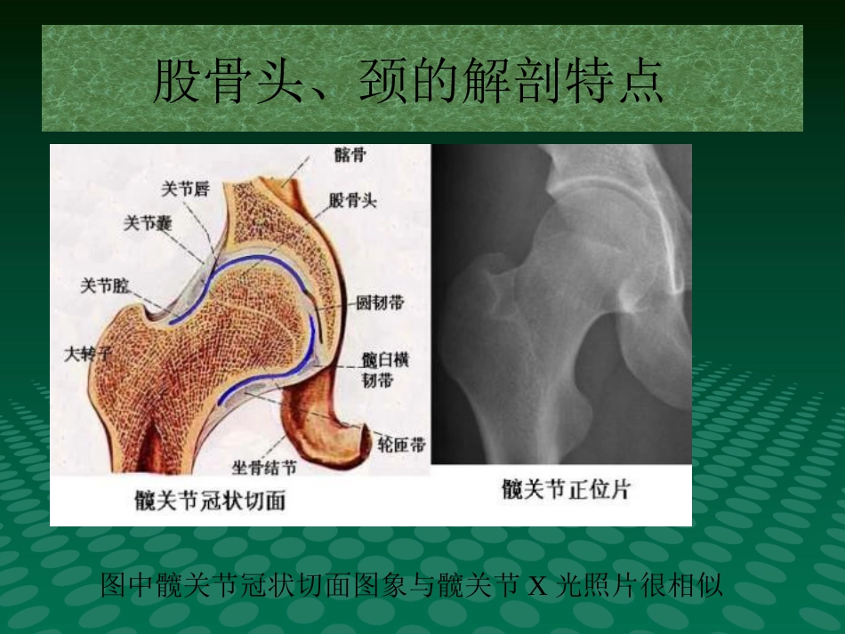 编辑股骨头缺血坏死影像学诊断_第3页