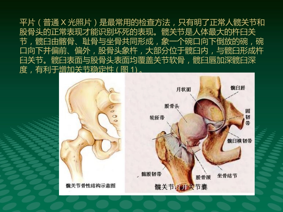 编辑股骨头缺血坏死影像学诊断_第5页