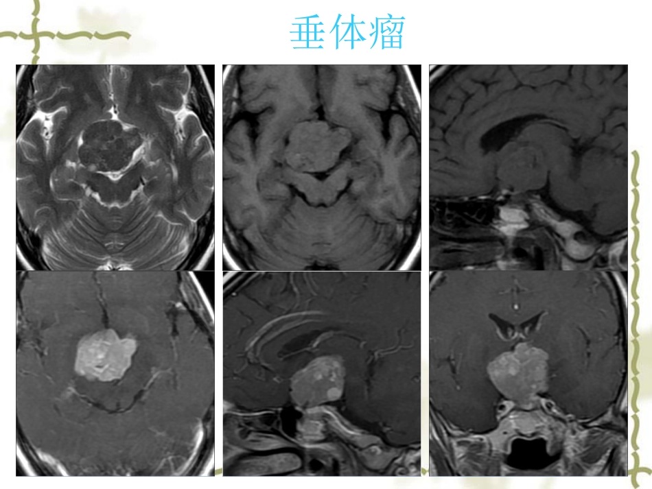鞍区肿瘤影像表现PPT_第10页