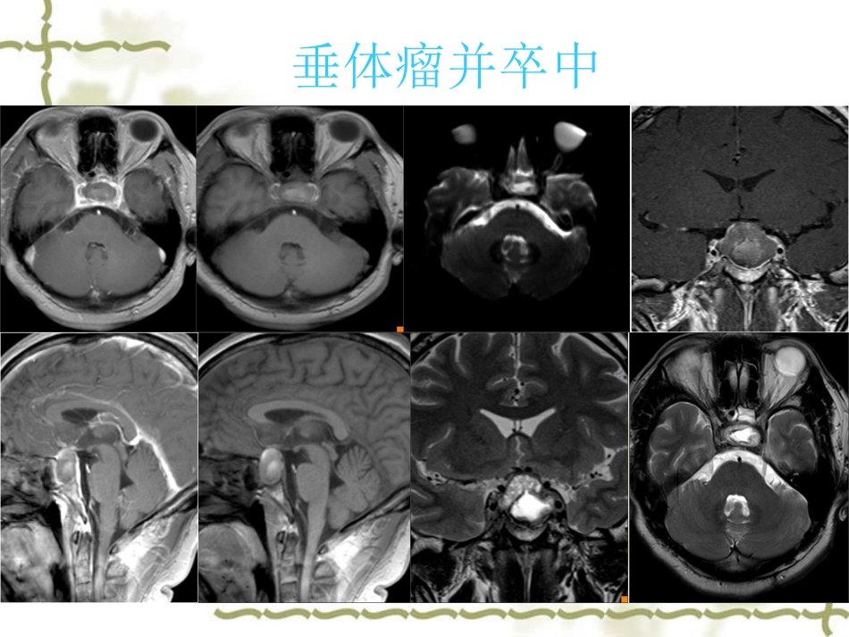 鞍区肿瘤影像表现PPT_第11页