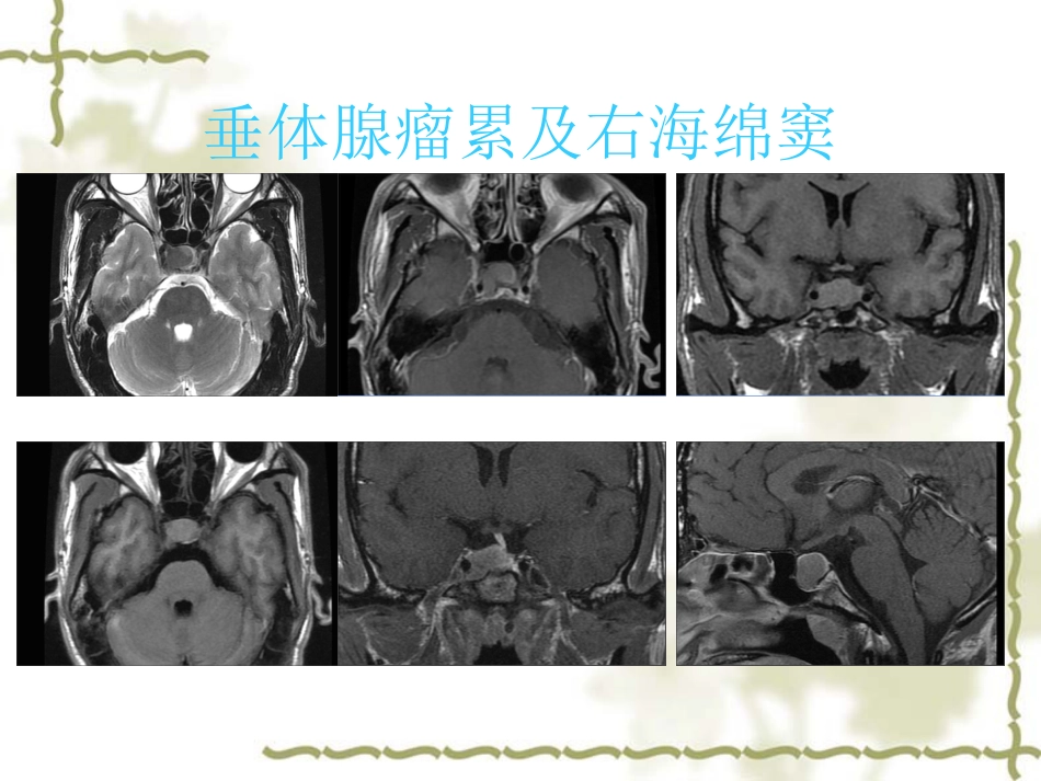 鞍区肿瘤影像表现PPT_第12页