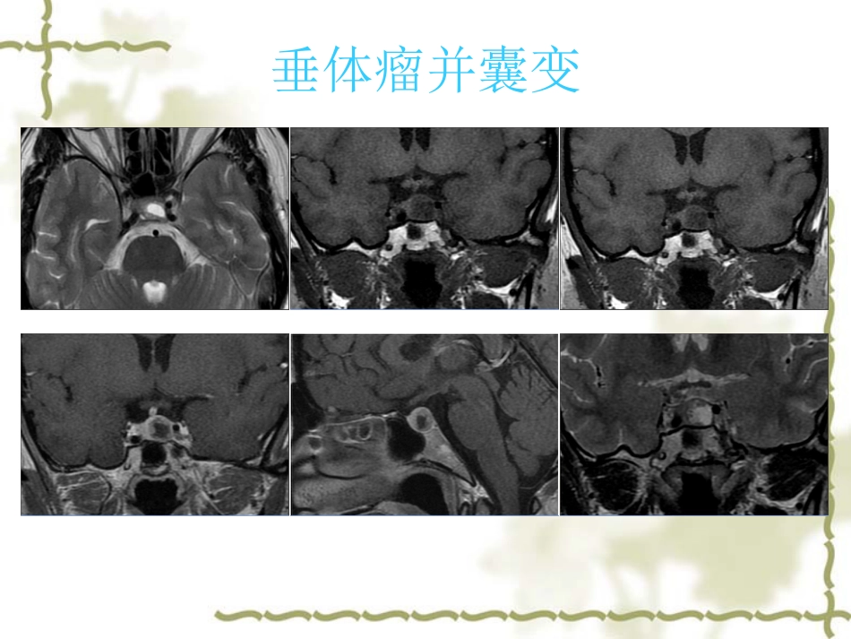 鞍区肿瘤影像表现PPT_第13页
