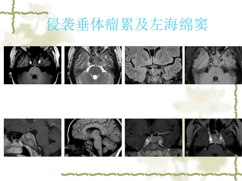 鞍区肿瘤影像表现PPT_第14页