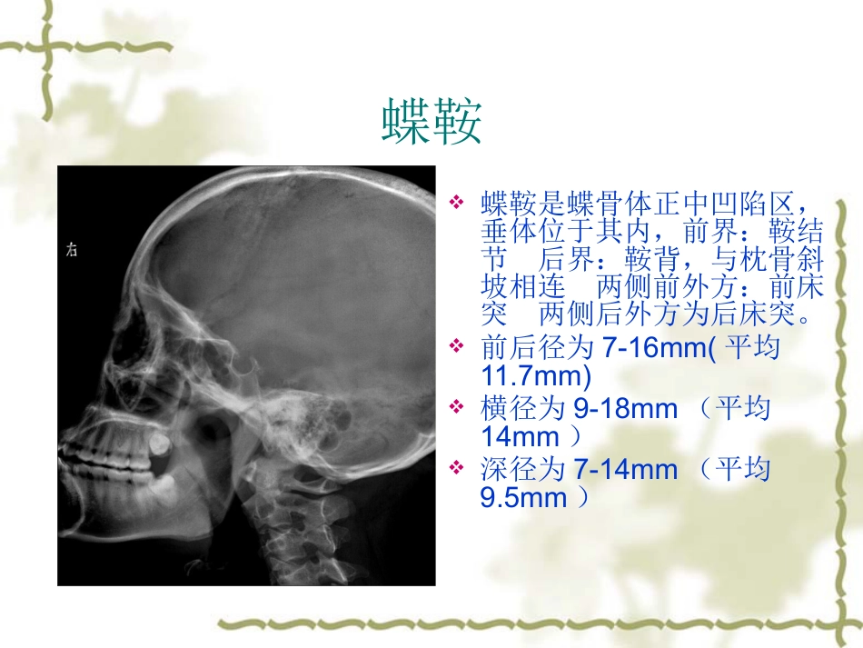 鞍区肿瘤影像表现PPT_第2页